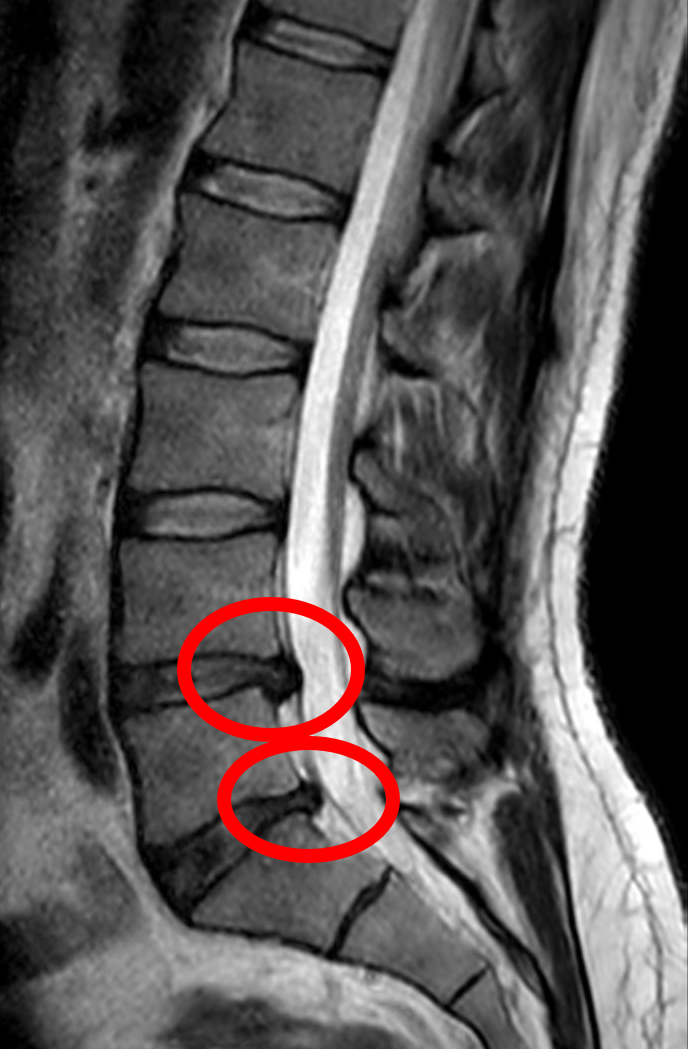 <p>herniated nucleus pulposus (HNP)</p>