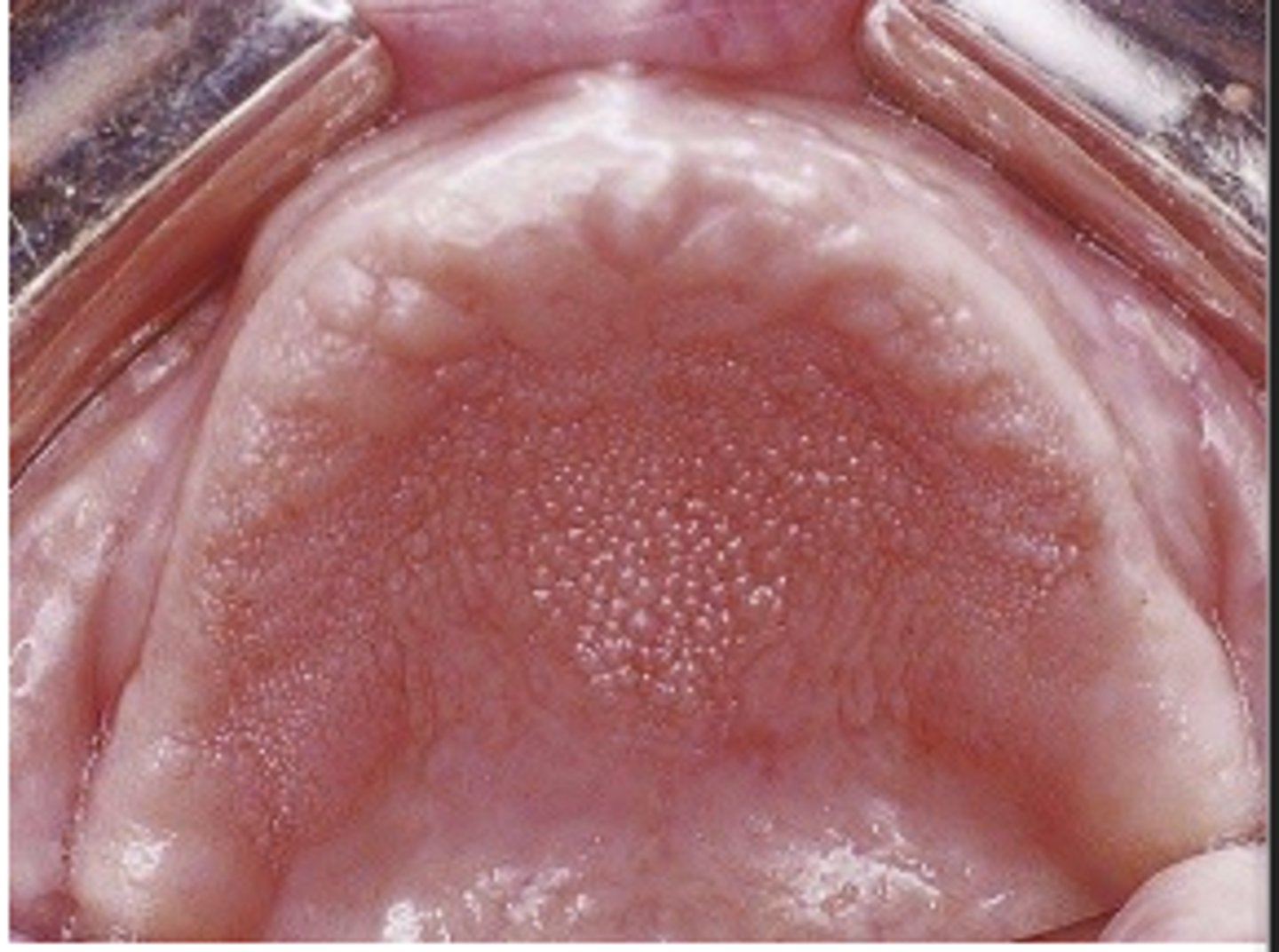 <p>Inflammatory papillary hyperplasia was asymptomatic, scenario: pt is using half a thing of denture glue to hold it in place. What is tx?</p>