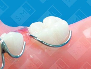 <p>Circumferential clasp</p><p>Engages in the mesial or distal undercut</p>