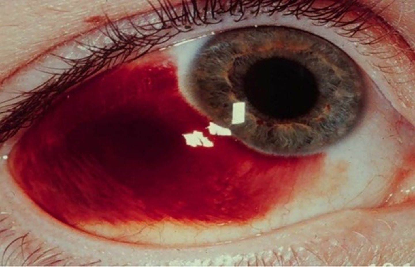 <p>blood vessel rupture in the eye</p>