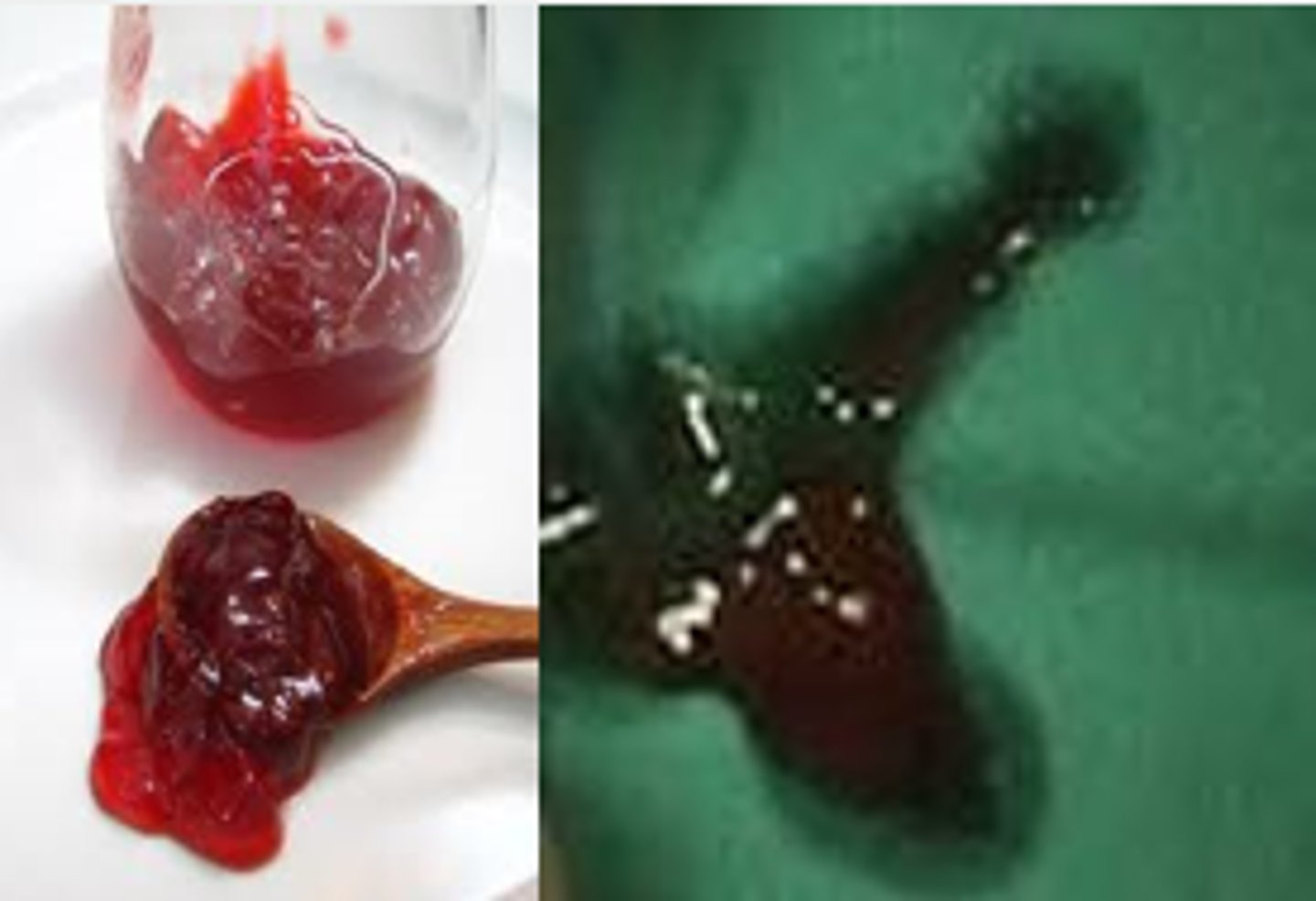 <p>Bouts of severe colicky abdominal pain (interspaced by periods of lethargy), vomiting, blood in the stool ("currant jelly stool" = buzzword), possible sausage-shaped mass on PE</p>