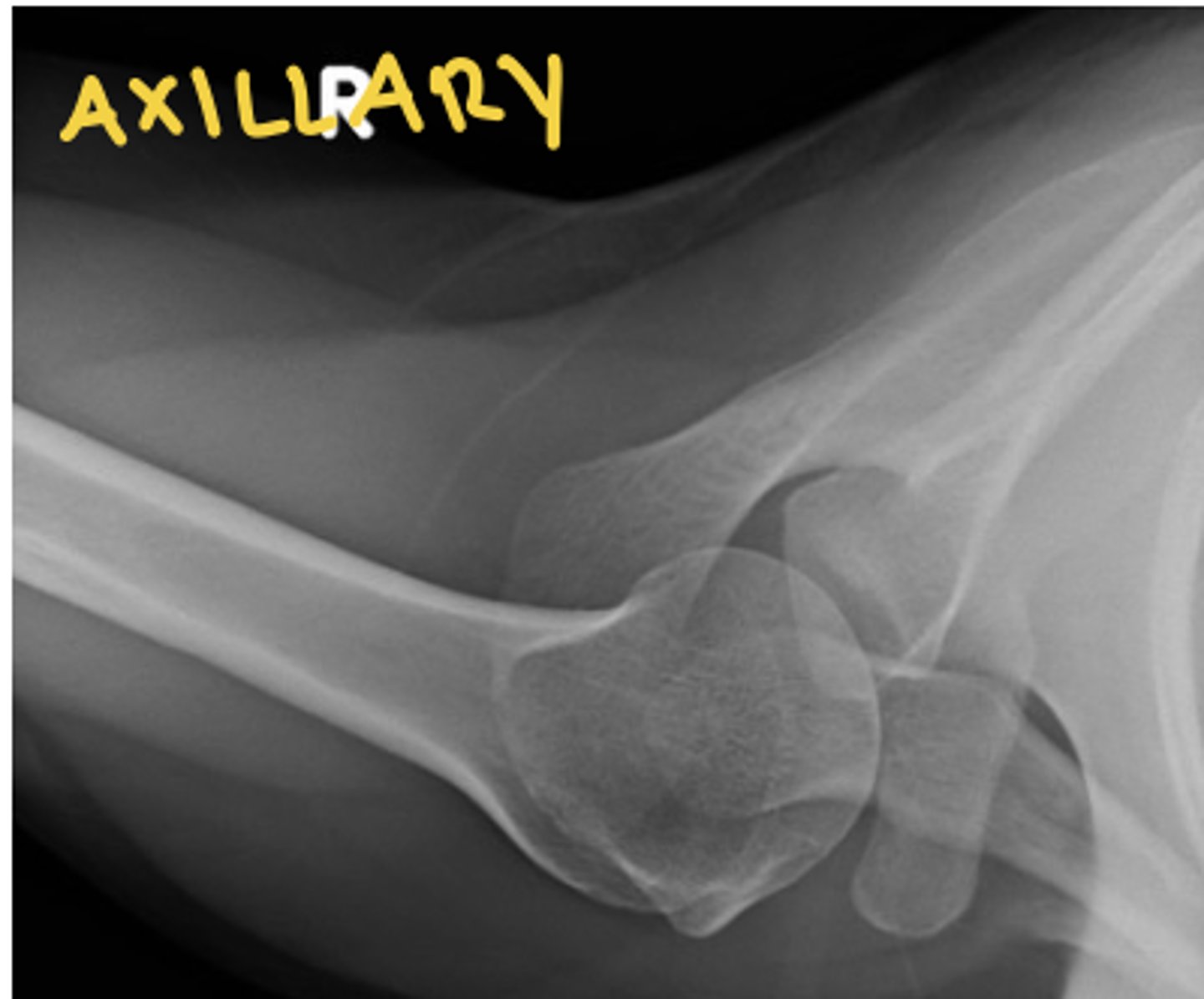 <p>see acromion, glenoid, and coracoid</p>