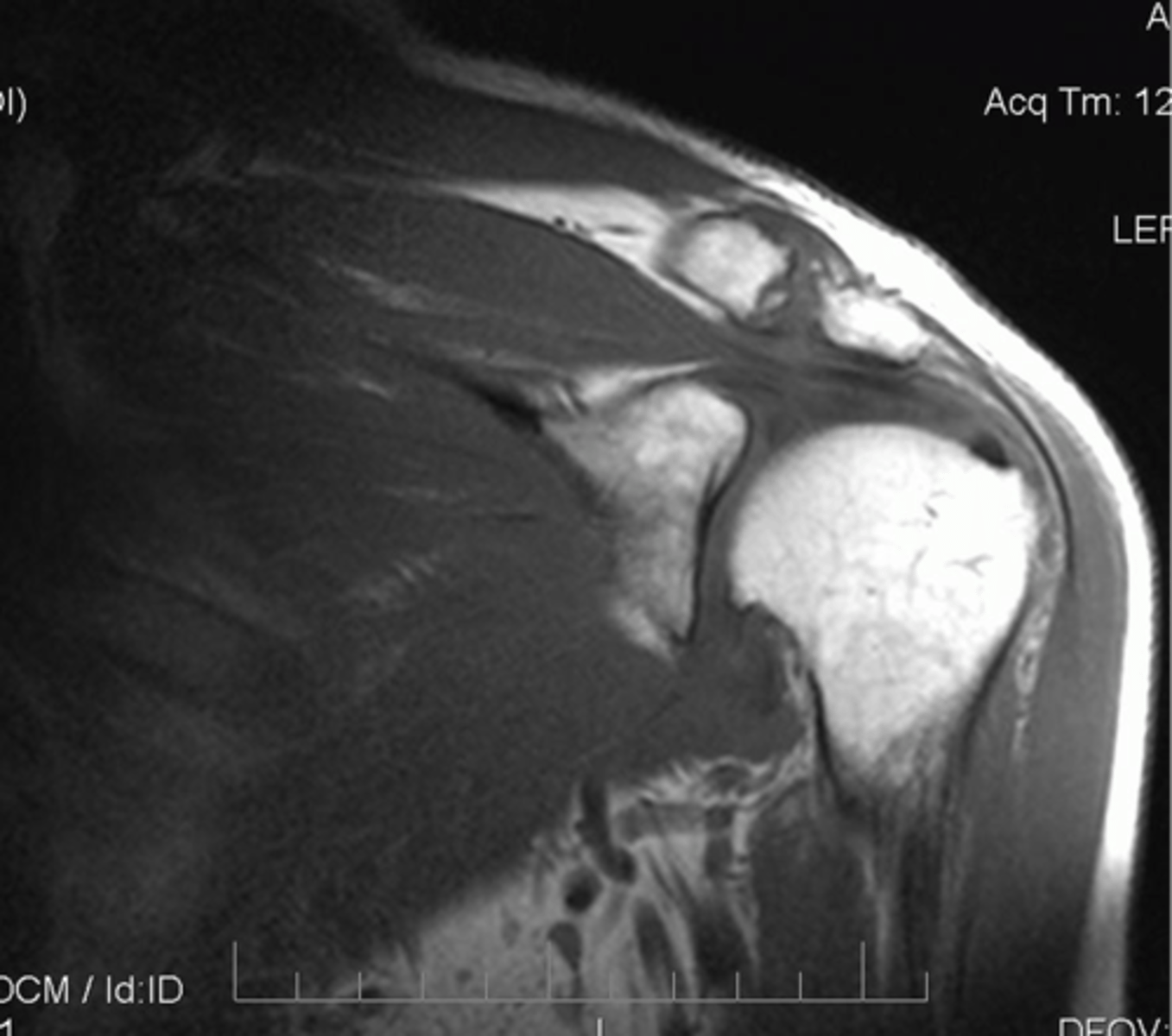 <p>Case: a 73-year-old swimmer fell on a boat in rough weather. There was expansion of the ACJ, impingement of the supraspinatus, erosions of articular surfaces, and subdeltoid hematoma (chronic).</p><p>Which changes may occur as a result of this accident?</p>