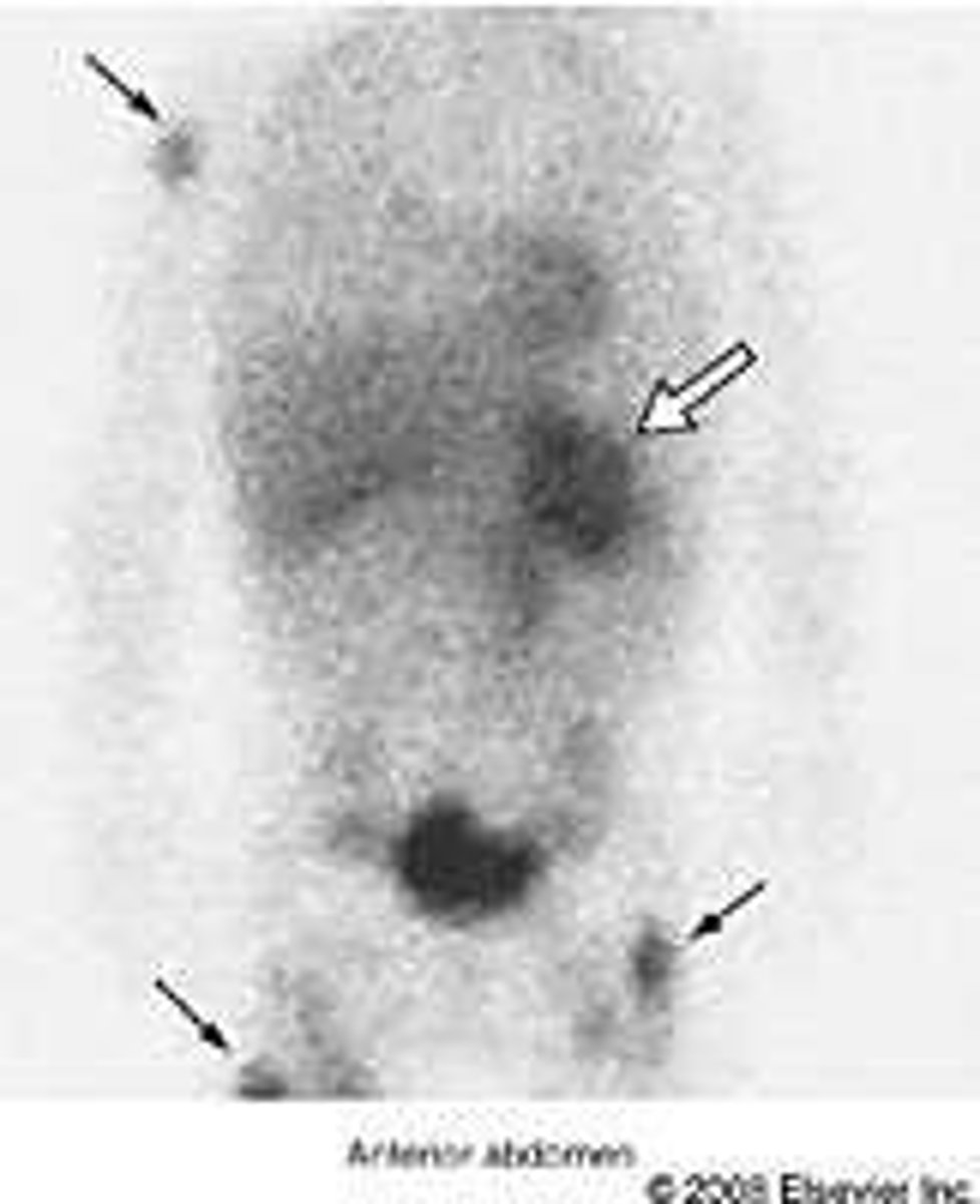 <p>A nuclear medicine scan used to identify neuroblastoma sites; requires thyroid protection with iodine solution.</p>