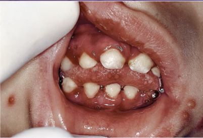 <p>what is the cause of this lesion </p>