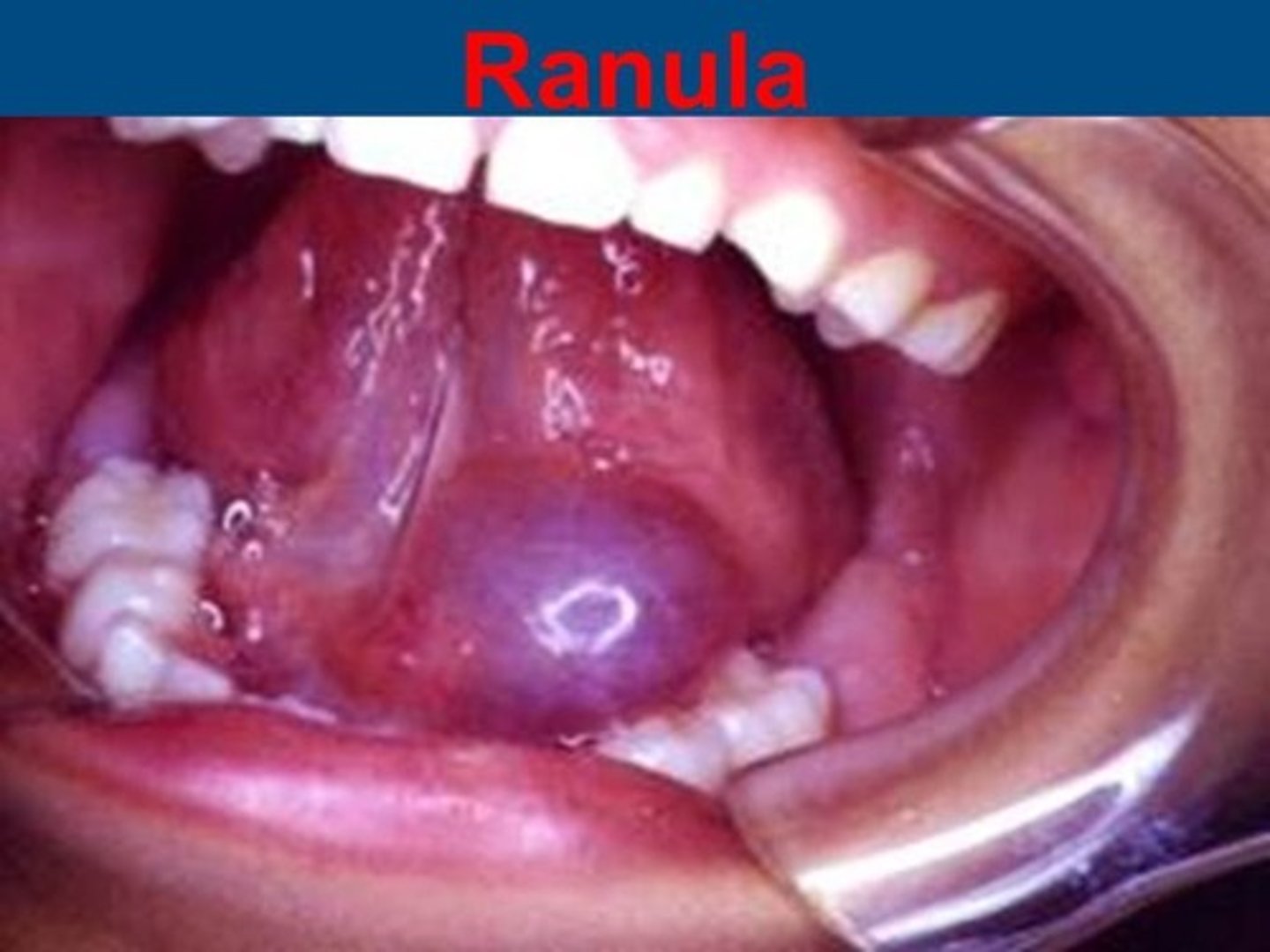 <p>large mucocele</p><p>• common location: floor of mouth - unilateral</p><p>• blockage of submand/sublingual gland </p>