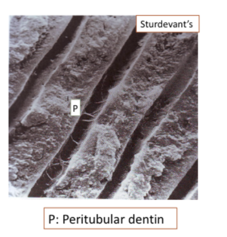<p><span>• Formed on the walls of dentinal tubules<br>diminishing their lumen progressively.<br>• Very mineralized. Poor in collagen fibers.<br>• Its formation is influenced by<br>environmental and pathologic factors.</span></p>