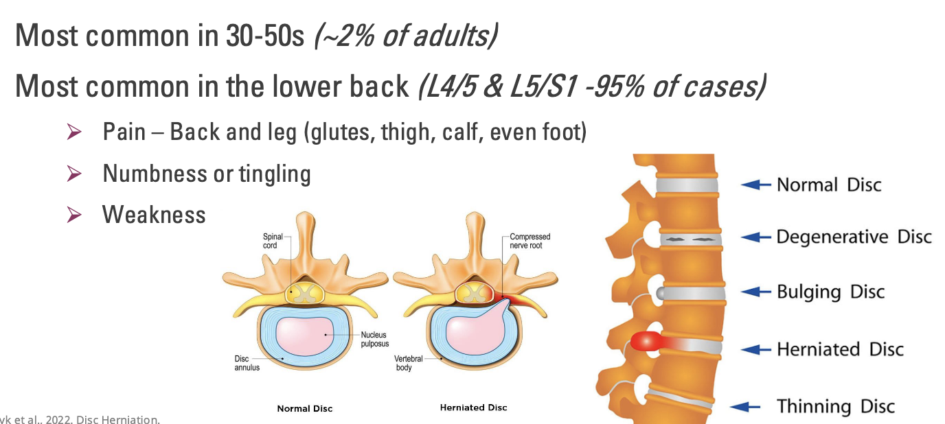 <p>Most common in 30-50s <em>(~2% of adults)</em></p><p>Most common in the lower back (<em>L4/5 &amp; L5/S1 -95% of cases</em>)</p><ul><li><p>Pain – Back and leg (glutes, thigh, calf, even foot)</p></li><li><p>Numbness or tingling</p></li><li><p>Weakness</p></li></ul><p></p><p><em>**Reported as pairs, because we talk about the disc in between the 2 vertebra</em></p>