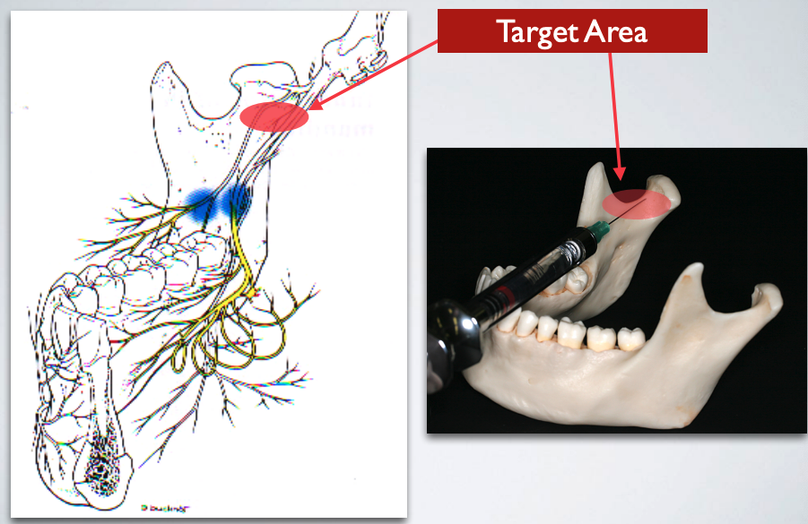 <p>target area of which technique?</p>