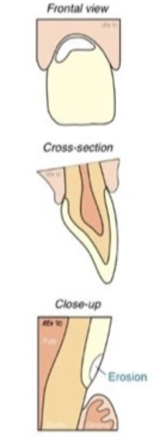 <p>What is erosion?</p>