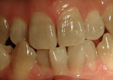 <ul><li><p><span style="background-color: transparent;">Multiple crossbites</span></p></li><li><p><span style="background-color: transparent;">when the lower canine-lateral-central&nbsp;sits in front of the upper </span></p></li></ul><img src="https://knowt-user-attachments.s3.amazonaws.com/023a738d-8816-4747-a58e-a0639e54ebab.png" data-width="75%" data-align="center"><p></p>