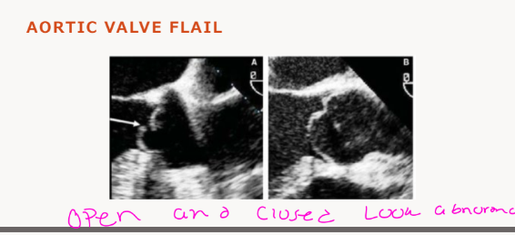 <p>Diastolic fluttering of the aortic cusp echoes,</p><p>abnormal systolic aortic leaflet movement, and</p><p>abnormal diastolic fluttering echoes in the left</p><p>ventricular outflow tract</p>