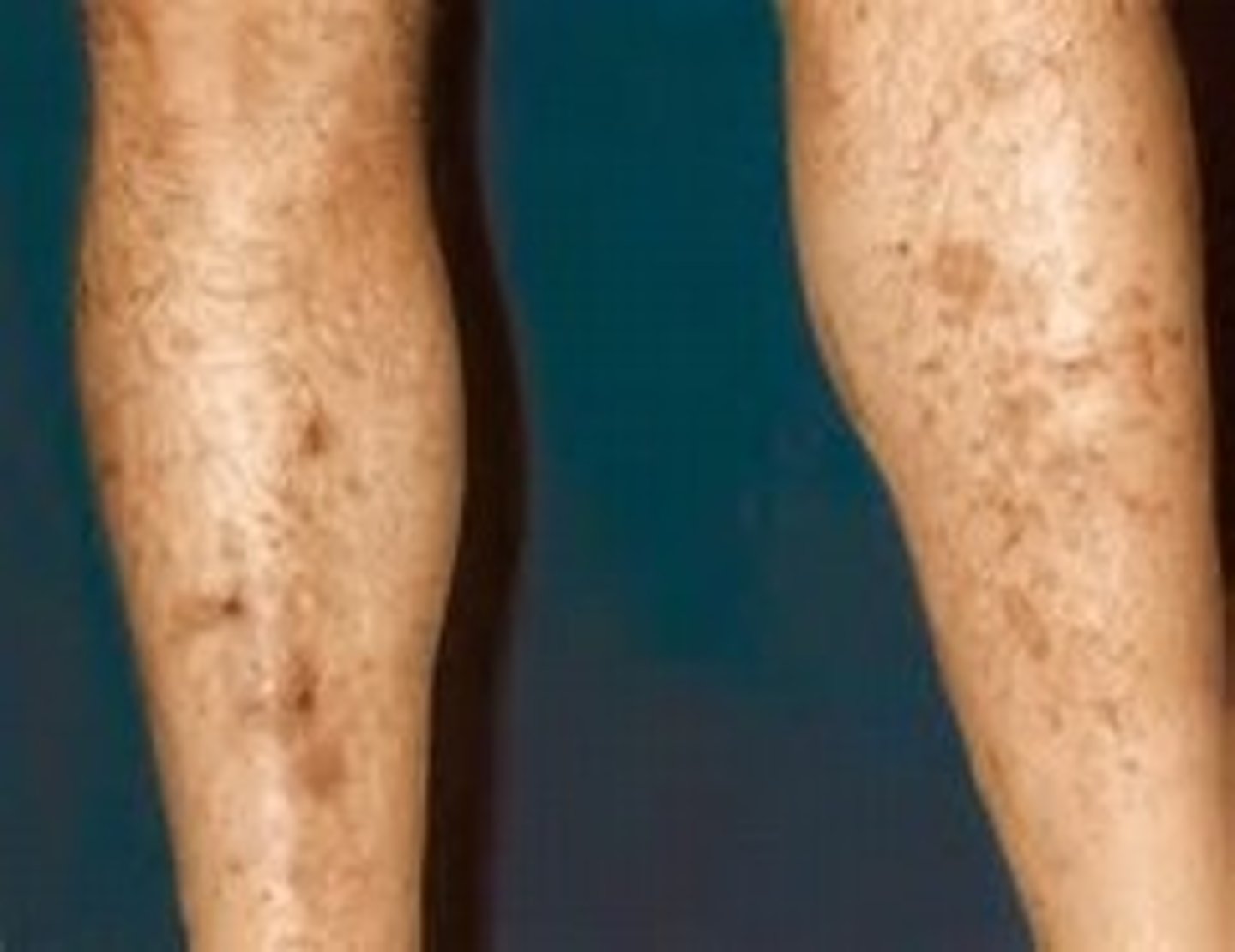 <p>Most common</p><p>Red-brown, round or oval patches</p>