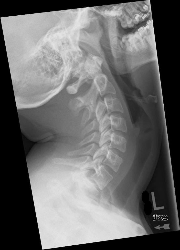 <p>They are almost identical, except the mandible appears almost horizontal and spinous processes are depressed/closely spaced.</p>