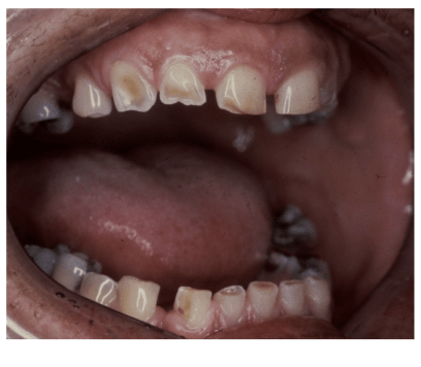 <p>wearing away of the tooth structure caused by an repetitive mechanical habit like aggressive toothbrush/flossing or holding sharp things in the mouth</p><p>commonly seen on exposed root surfaces where dentin and cementum are exposed</p><p>appears as a notching of the root surface in areas of gingival recession</p><p>increase risk for hypersensitivity and caries</p>