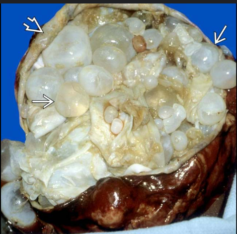 <p>hydatid cysts</p>