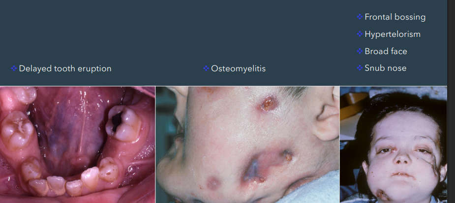 <ul><li><p>delayed tooth eruption </p></li><li><p>osteomyelitis </p></li><li><p>frontal bossing </p></li><li><p>hypertelorism </p></li><li><p>broad face </p></li><li><p>snub nose </p></li></ul><p></p>