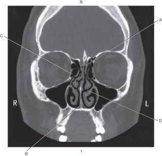<p>Which line points to the middle nasal meatus?</p>
