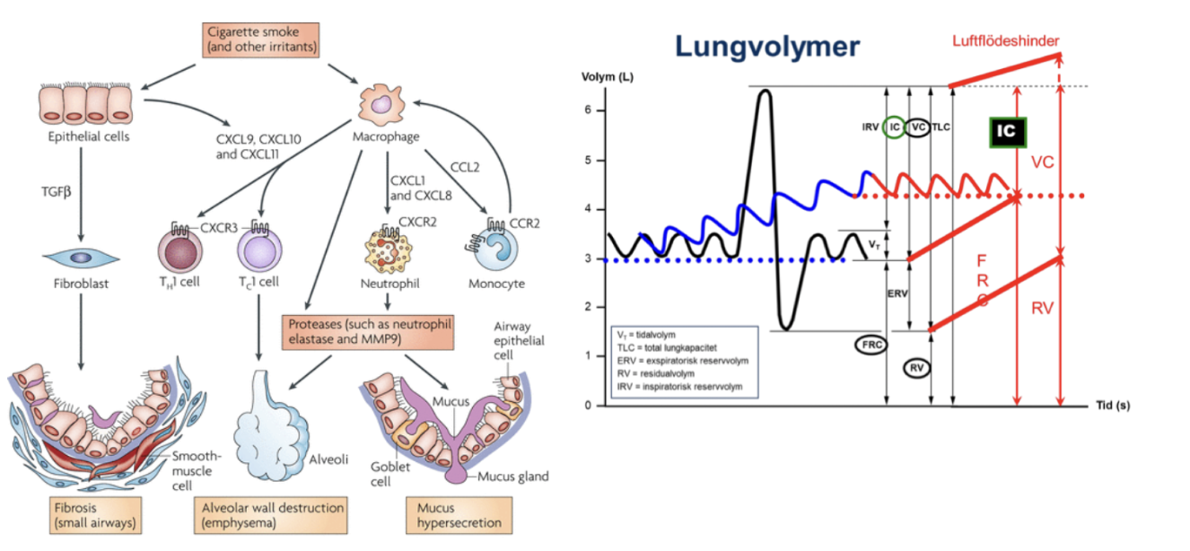 <p>Den minskade elasticiteten och infästningarna mellan alveoler och bronkioler leder till “air trapping” och <strong>minskad expiratorisk förmåga</strong>. Återfjädringskraften i lungorna blir mindre.</p><p>Det leder till en <strong>minskad FVC </strong>och därmed även FEV<sub>1</sub>. Det leder till ett <strong>förhöjt andiningsmedelläge</strong> med ökad residualvolym.</p>