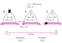 <p><span data-name="orange_square" data-type="emoji">🟧</span> <strong>Altération du rapport ventilation/perfusion (V/Q)</strong></p><p><span>Que se passe-t-il en cas de perfusion nulle (cas C) ?</span></p>