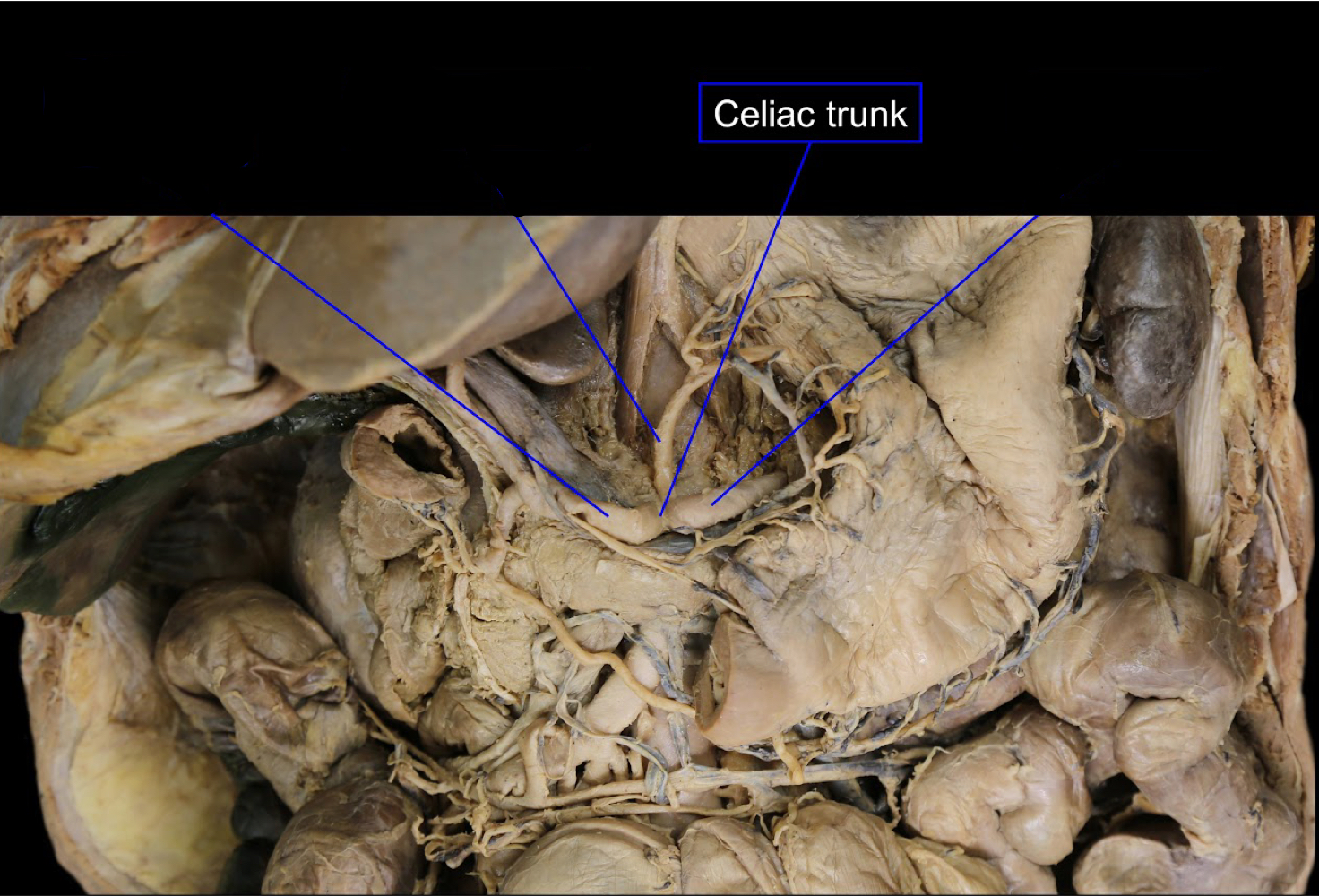 <p>foregut<br>(highlighted: celiac trunk)</p>