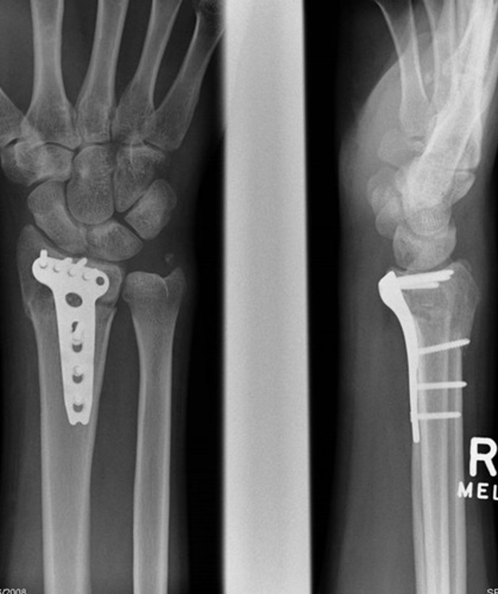 <p>surgical internal fixation (with use of things like pins, screws, and plates); puts patient at risk of infection, anesthesia complications, and healing complications with comorbid disease (pt with preexisting issues such as DM and heart problems will have more difficulties)</p>