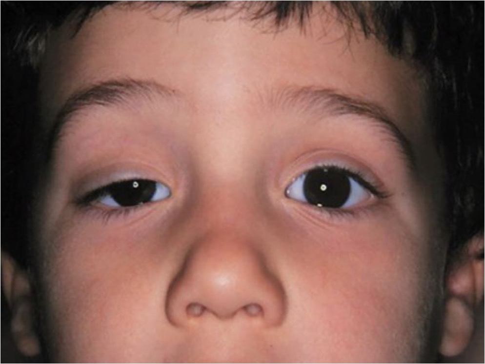 <p>damage to pathway in SNS that regulates HR, <strong>pupil size</strong>, perspiration, BP, etc; results in <strong>ptosis, miosis, anhidrosis</strong></p>