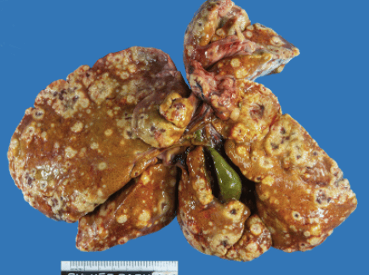 <p>How would you describe this lesion based on the shape?</p>