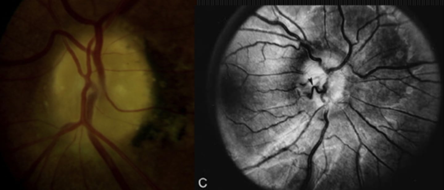 <p>papilledema = optociliary shunts develop, venous dilation, absent SVP</p><p>drusen = central origin, trifurcation and other anomalous patterns, present SVP</p>