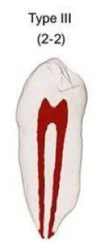 <p>2 distinct canals from pulp chamber to canal terminus </p>