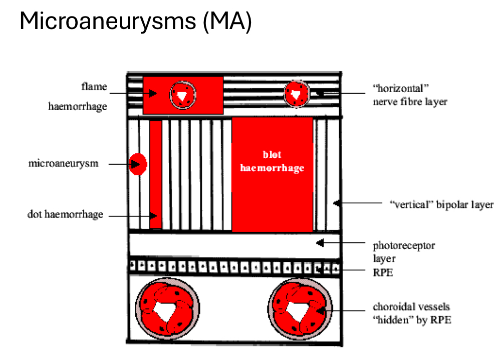 <p>define microaneurysms (MA)</p>