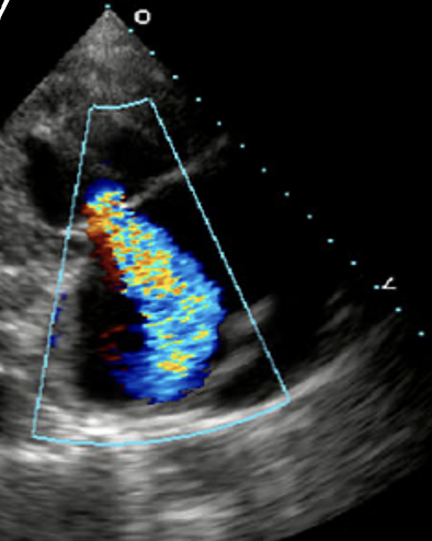 <p>The most common cause of Tricuspid Regurgitation is?</p>