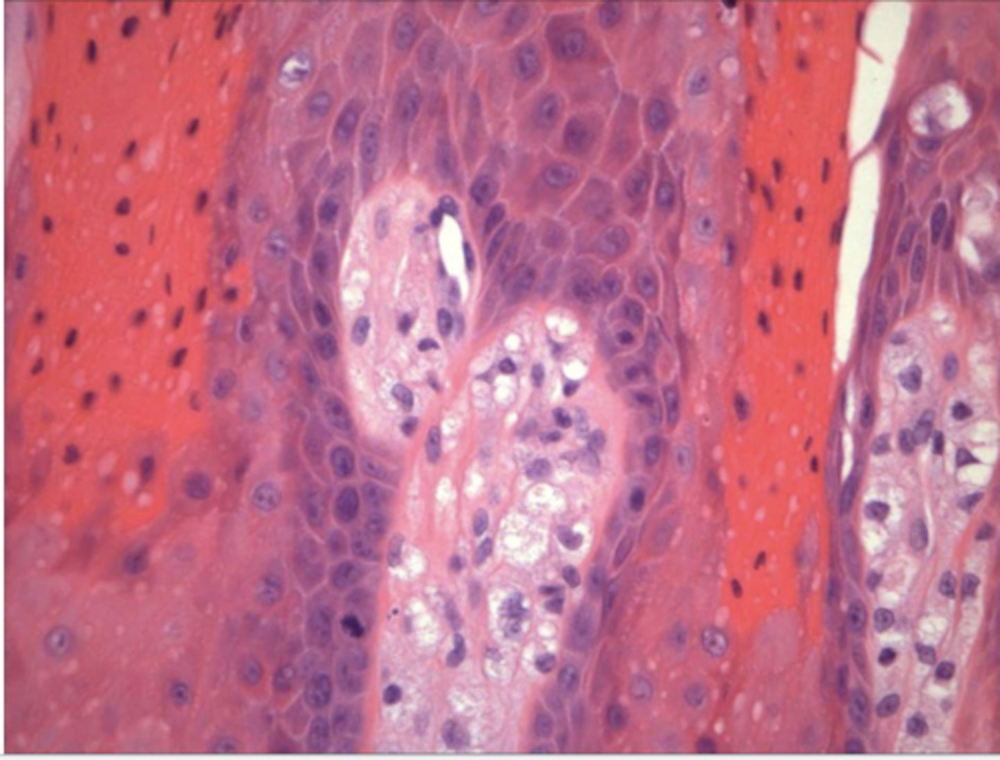 <p>the following describe the histopathological features of what?</p><p>-papillary, acanthoic surface covered by parakeratin</p><p>-large macrophages w/ foamy cytopalsm</p>
