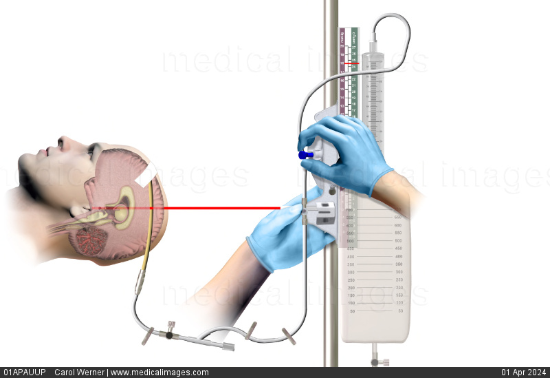 <p>What is an important intervention to consider when taking care of a patient with an EVD? </p><p>a. Make sure to keep the bag above the laser line.</p><p>b. The patient can have the EVD running while using the bathroom. </p><p>c. Make sure to clamp the tubing before the patient gets up.</p><p>d. Make sure the patient knows how to take care of the EVD at home. </p>