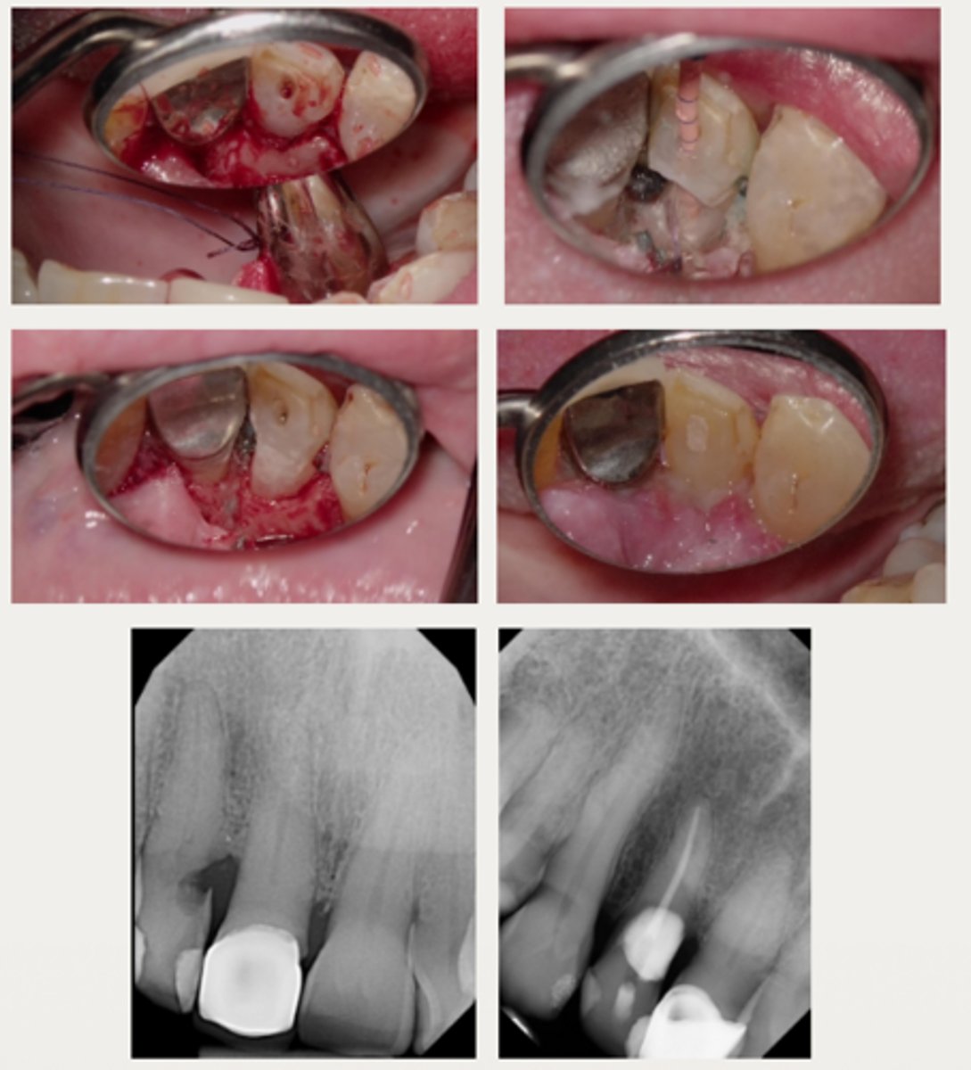 <p>These are a part of which treatment for External Cervical Resorption (ECR)?</p><p>For lesions with a large portal of entry where the resorptive defect would be accessible by raising a flap without having to remove excessive marginal bone:</p><p>- Same as the external repair only approach</p><p>- RCT may be completed before or after the repair, if care is taken to prevent canal blockage when restoring the defect first</p>