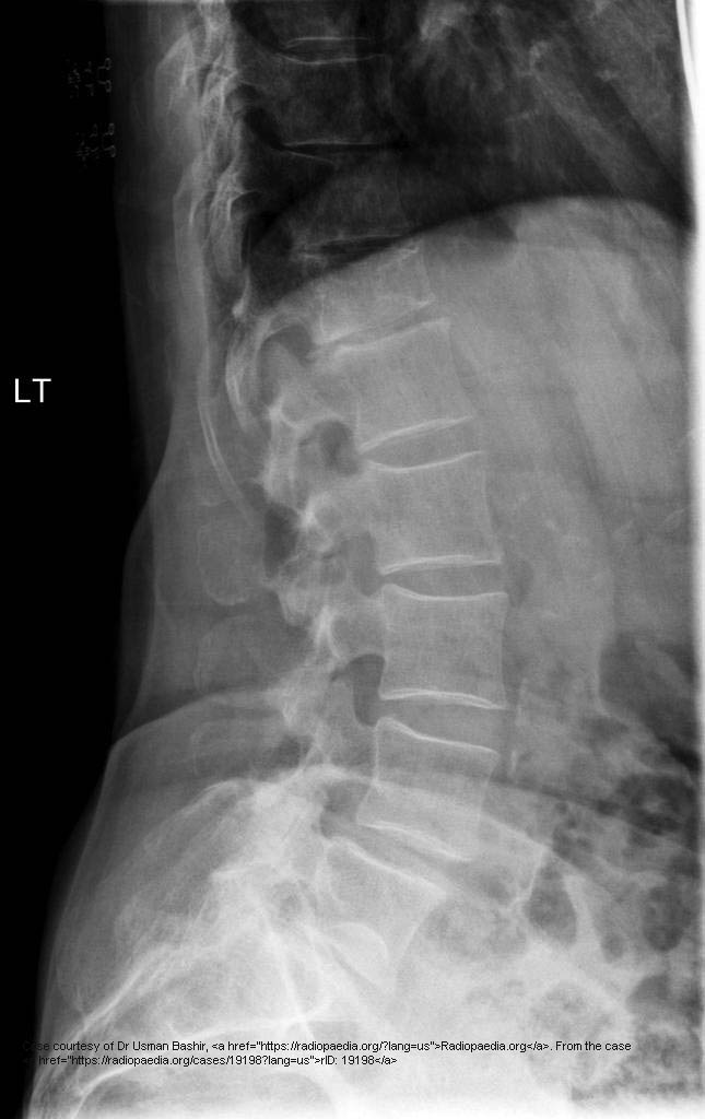 <p>Osteoporosis and metastases.</p>