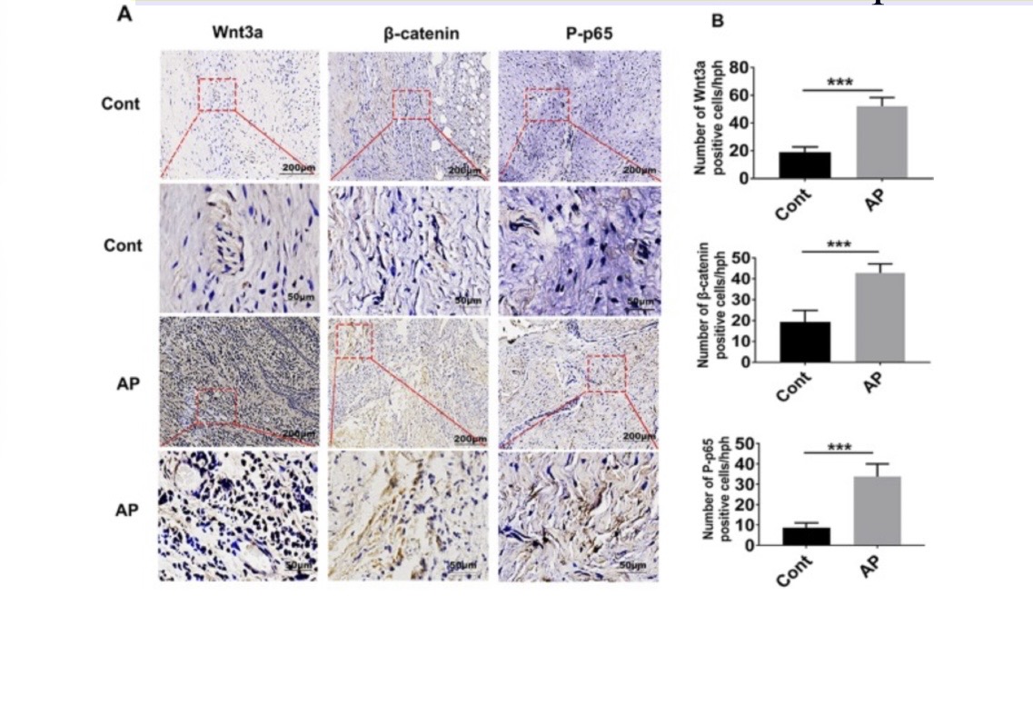 <p>Apical periodontitis (AP) is inflammation of the gums caused by</p><p>plaque buildup on teeth near the gumline. Which of the following conclusions are supported by the graph on the left?</p><p>Select ALL that apply.</p><p>1. Wnt and b-catenin are both activating the same downstream</p><p>protein.</p><p>2. There is a greater expression of Wnt in AP patients than in</p><p>control patients.</p><p>3. Wnt and b-catenin have similar expression profiles.</p><p>4. These data do not show a dose-dependent response.</p>