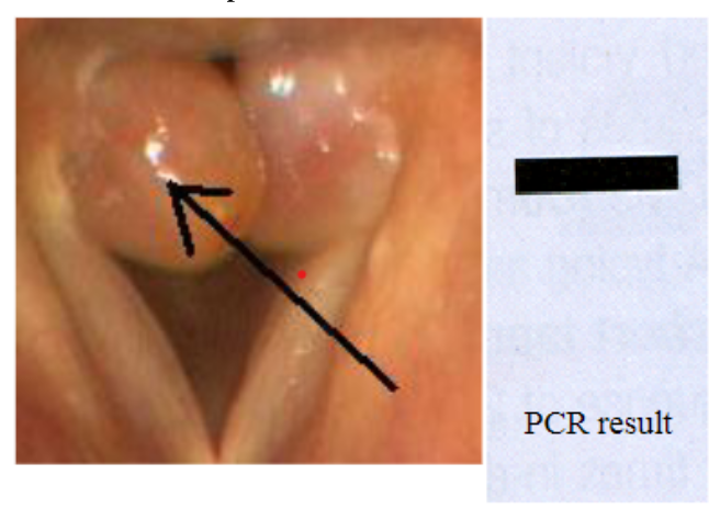 <p>39. A patient comes to your clinic with the structures shown below on his vocal cords. Y ou take a biopsy of</p><p class="p1">the structure indicated by the arrow. PCR primers are prepared complementary to the 3' ends of a</p><p class="p1">bacterial gene, and a reaction is performed on the biopsied tissue. The results are shown after</p><p class="p1">electrophoresis. What is the best interpretation of this data?</p><p class="p1">A. The PCR has been done wrong. One primer should be complementary to the 3' end and the</p><p class="p1">other should be complementary to the 5' end of the gene.</p><p class="p1">B. The patient's macrophages are in the process of digesting the bacteria and releasing</p><p class="p1">the DNA.</p><p class="p1">C. The patient has a granuloma, and may need long term antibiotics to treat it.</p><p class="p1">D. The patient has a tumor, which was caused by insertion of bacterial DNA.</p><p class="p1">E. The bacterium is actively replicating its DNA, which was detected by the</p><p class="p1">PCR.</p>