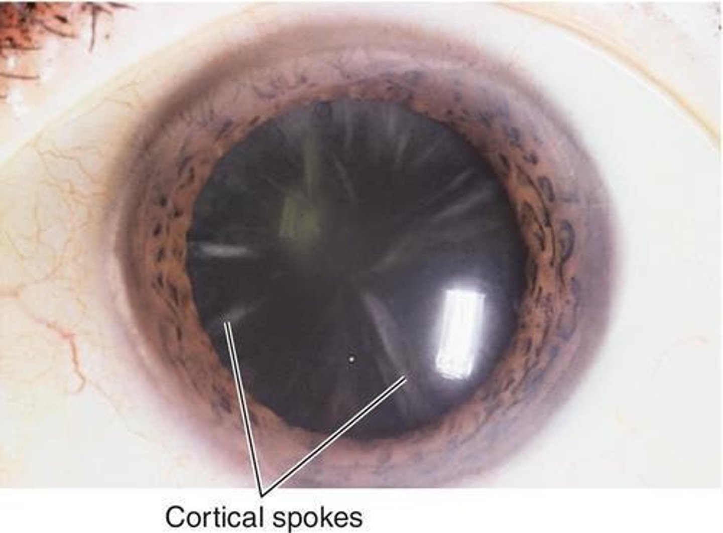 <p>Wedge-shaped opacities in the lens that can compromise visual acuity, especially when they encroach upon the visual axis.</p>