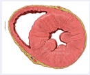 <p><span>Mammals: Cardiomyocyte are present but don’t divide; Progenitors present, but not used?</span></p><p style="text-align: left"><span>Scar/maladaptive hypertrophy</span></p><p style="text-align: left"></p><p style="text-align: left"><span>Ventricular regeneration in zebrafish</span></p><p style="text-align: left"><span>Not identical to embryonic heart development eg.</span></p><p style="text-align: left"><span>&nbsp; &nbsp;msxB and C expressed</span></p><p style="text-align: left"><span>Regeneration dependent on <strong>dedifferentiating muscle cells</strong></span></p><p style="text-align: left"><span>Endocardium /Epicardium are involved</span></p><p style="text-align: left"><span><strong>Neuregulin </strong>may be a signal from the epicard, inducing proliferation in myocard</span></p><p style="text-align: left"></p><p style="text-align: left"><span>Scarring vs regeneration</span></p><p style="text-align: left"><span>&nbsp; zebrafish mps1 mutants show scarring rather than regeneration</span></p><p></p><p><span>Due to its importance for human health. I would also like to touch on vertebrate heart regeneration. Cardiac cells in the mammalian heart hardly divide.</span></p><p style="text-align: left"><span>More recent work on mammalian hearts suggests that progenitors that can differentiate into muscle may in fact be present, but somehow they are not used when tissue is damaged. Rather, necrotic tissue that forms after infarction is replaced by scar tissue. In addition, there is a hypertophic response of the remaining muscle cells, which is thought to be maladaptive, and may in fact increase the risk of further infarction.</span></p><p style="text-align: left"><span>In zebrafish however the ventricle of the heart can be regenerated. Due to differences in scale and also by looking at molecular markers it is clear that this regeneration is not identical to embryonic heart formation. For instance, Msxb and Msxc are expressed during regeneration but not in development.</span></p><p style="text-align: left"><span>Recent data indicate regeneration is dependent on dedifferentiating muscle cells, and is not driven by stem cells.</span></p><p style="text-align: left"><span>Some molecular and cellular analysis has been performed on ventricular regeneration and it is clear that the epicardium and the endocardium are involved.</span></p><p style="text-align: left"><span>An important factor in regeneration is neuregulin, this signling molecule is expressed in the epicard and can induce proliferation in the myocard.</span></p><p style="text-align: left"></p><p style="text-align: left"><span>In general it is thought there may be a balance between regeneration and scarring, in zebrafish regeneration is the main process.However is regeneration cannot occur as for instance in an mps1 mutant, these fish will show scarring rather that regeneration just like humans.</span></p>