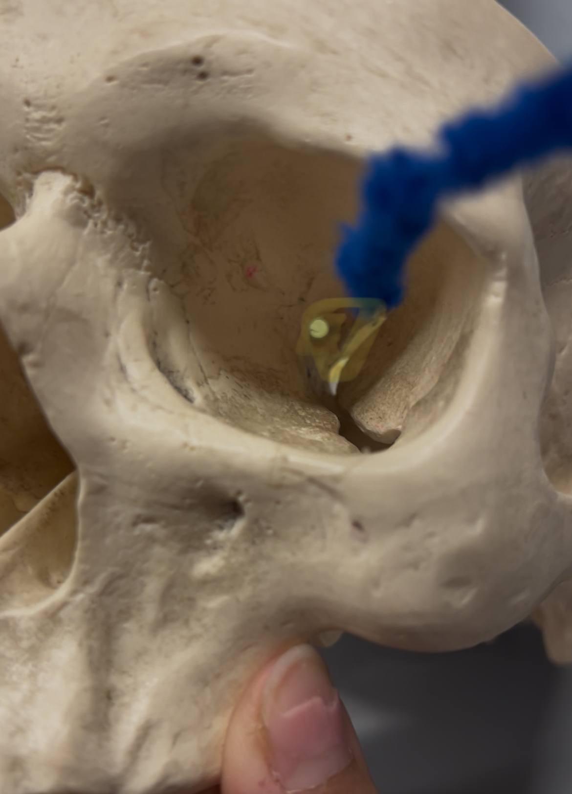 <p>Optic canal on the sphenoid/ optic nerve II passes here</p>