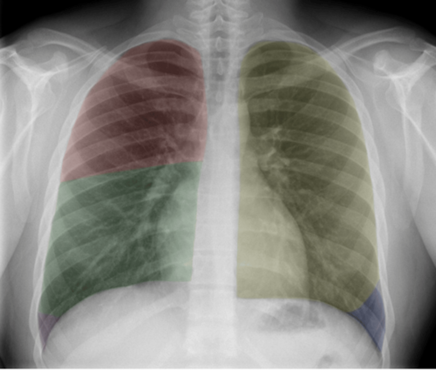 <p>•Red: Right upper lobe (RUL)</p><p>•Green: Right middle lobe (RML)</p><p>•Purple: Right lower lobe (RLL)</p><p>•Yellow: Left upper lobe (LUL)</p><p>•Blue: Left lower lobe (LLL)</p>