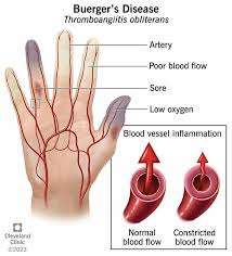 <p><strong>Thromboangiitis Obliterans: General Info</strong></p><p>-____________, segmental, inflammatory, and ________ disease that affects small-medium size vessels of the upper and lower extremities </p><p>-_____ &gt; females, most commonly in __-__ year old</p><p>-Risk Factors = ________ (rolling your own cigarettes) and severe periodontal disease</p>