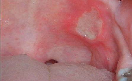 <p>1-3 cm (large)</p><p><strong>Healing time: 2-6 weeks</strong></p><p><strong>Biopsy to R/out cancer</strong></p><p><strong>Causes scarring sometimes</strong></p><p>1-10 lesions</p><p>Longest duration</p><p>More than minor; less than herpetiform</p>