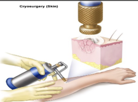 <p>Treatment for benign or small malignant lesions; liquid nitrogen is applied to the lesion to freeze / destroy it</p>