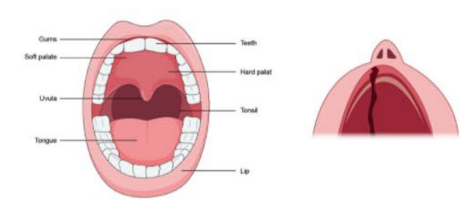 A congenital abnormality where there is a split, or gap, in the hard palate (the  roof of the mouth) 