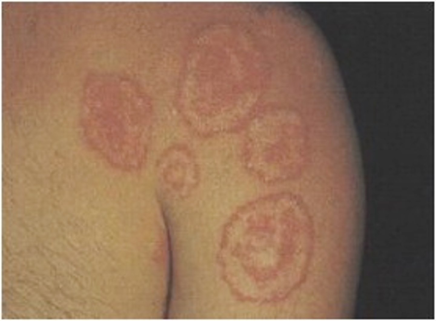 <p>ringworm of the body; annal lesions with scaly boarders and central clearing on the trunk</p>