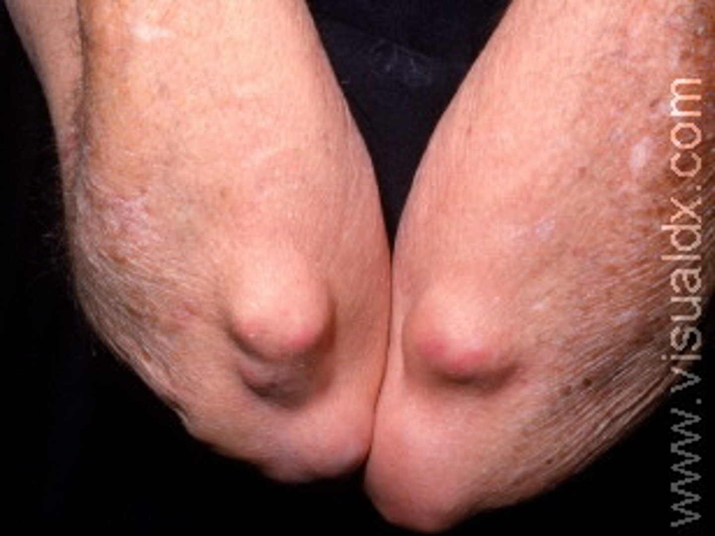 <p>Firm, nontender, unattached subcutaneous nodules at pressure points (e.g., elbow, back of forearm) associated with rheumatoid arthritis; develop in 20% of patients with RA</p>