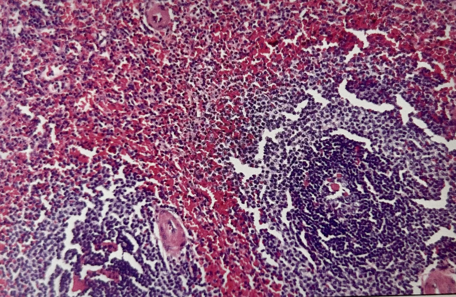 <p>The problem seen in this image most likely could have been prevented by:</p><p>a. immediate and prolonged fixation </p><p>b. less processing time</p><p>c. increased paraffin infiltration</p><p>d. better microtomy technique</p>
