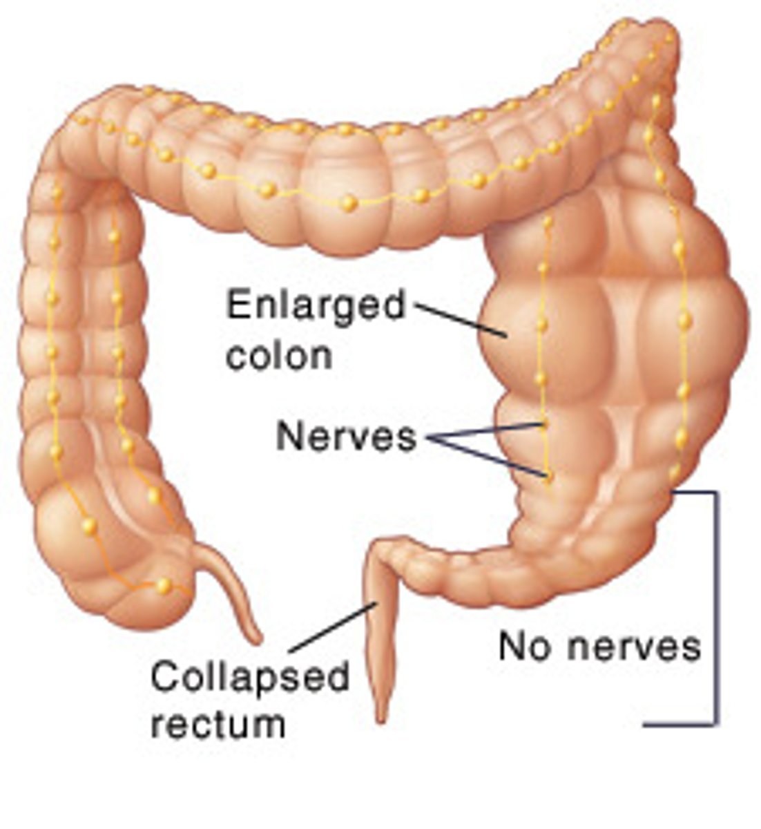 <p>Absence of ganglion cells in the mucosal &amp; muscular layers of a segment of the colon leads to impaired peristalsis; rectosigmoid area</p>